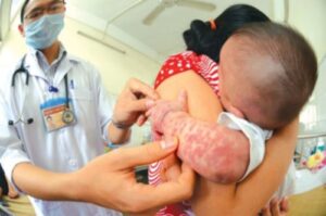 Vì sao dịch sởi bùng phát trở lại? 3 4446 homecare