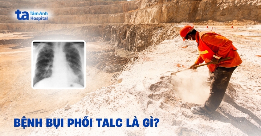 Benh Bui Phoi Talc