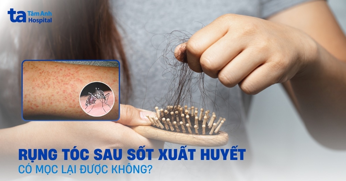 Bi Rung Toc Sau Khi Bi Sot Xuat Huyet