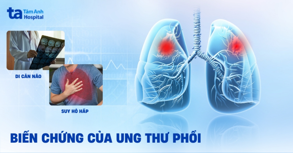 Bien Chung Cua Ung Thu Phoi