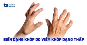 Bien Dang Khop Do Viem Khop Dang Thap