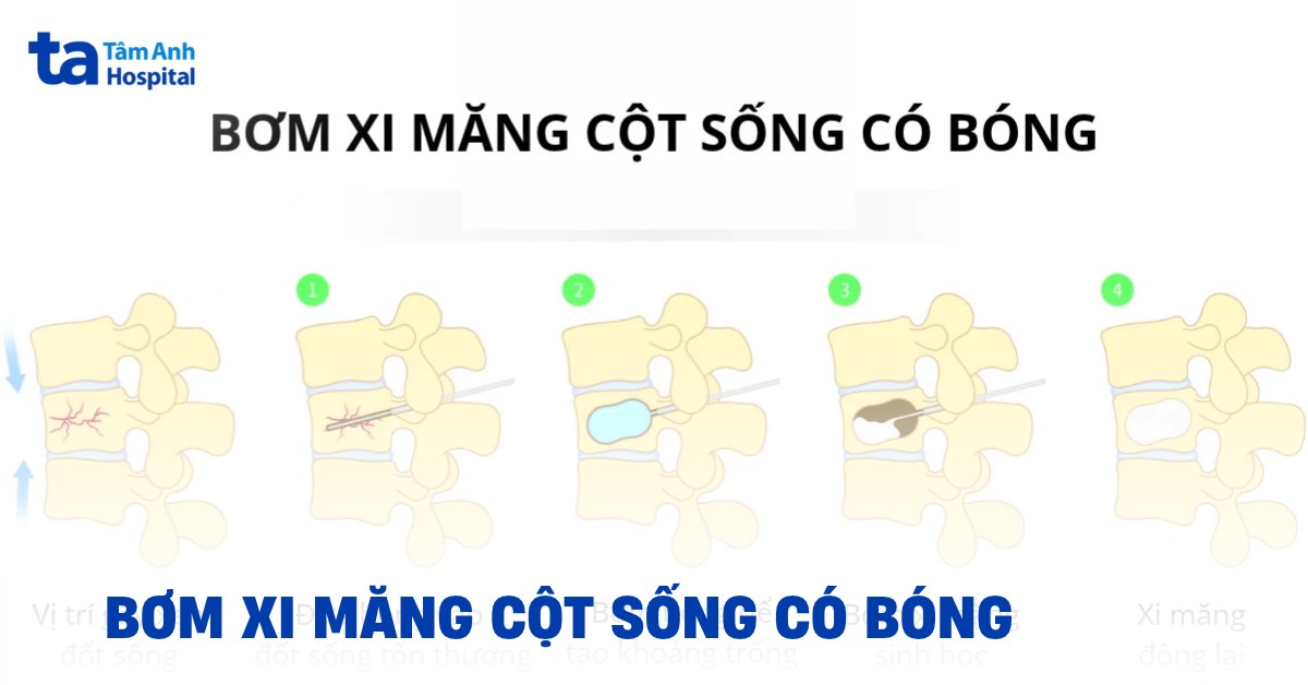 Bom Xi Mang Cot Song Co Bong