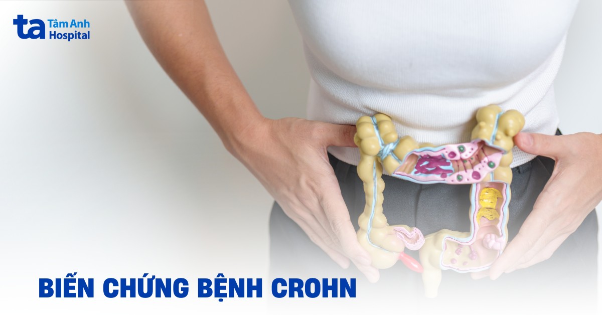 Cac Bien Chung Benh Crohn