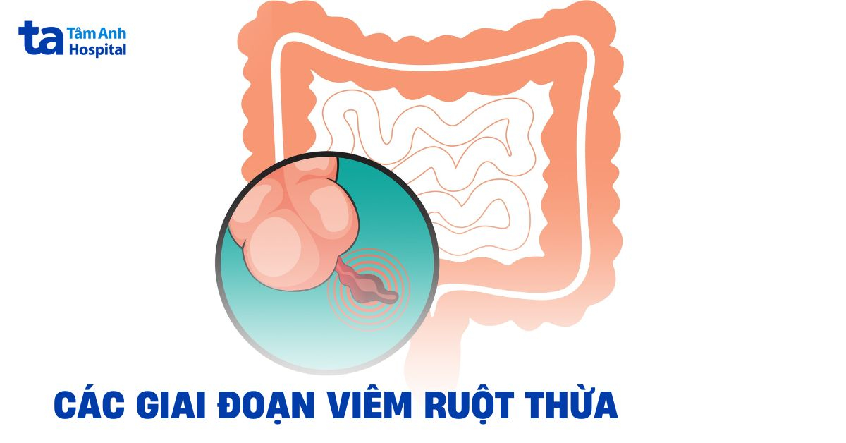Cac Giai Doan Viem Ruot Thua