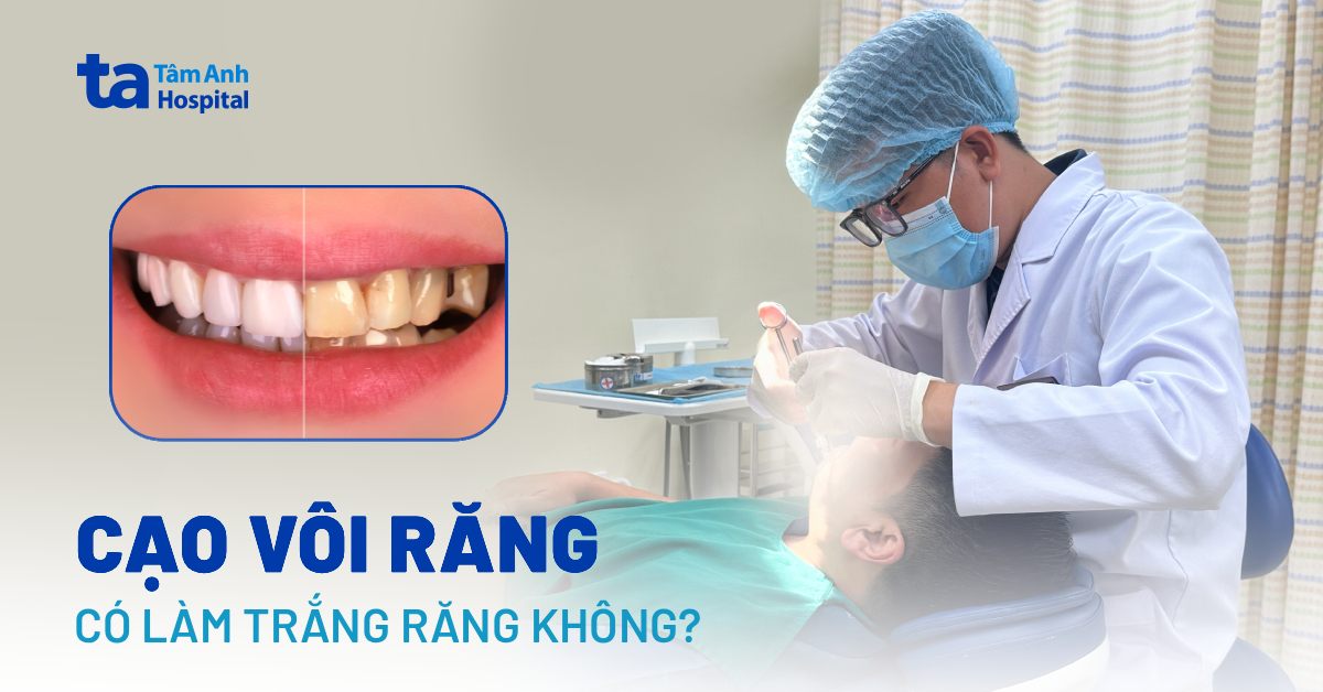 Cao Voi Rang Co Lam Trang Rang Khong