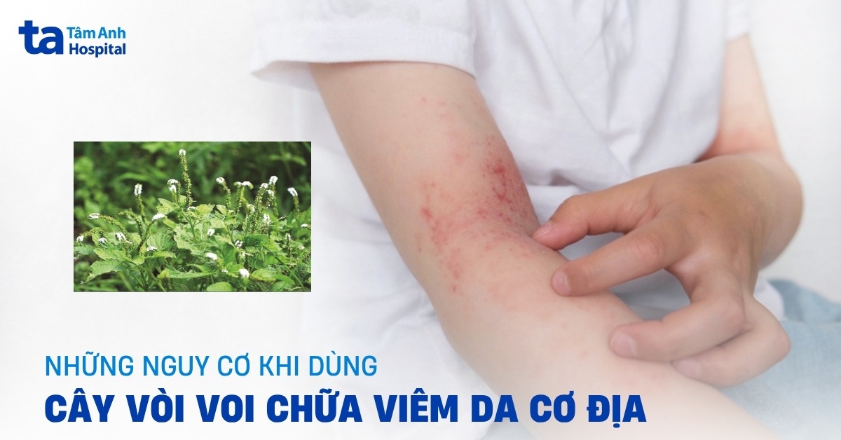 Cay Voi Voi Chua Viem Da Co Dia