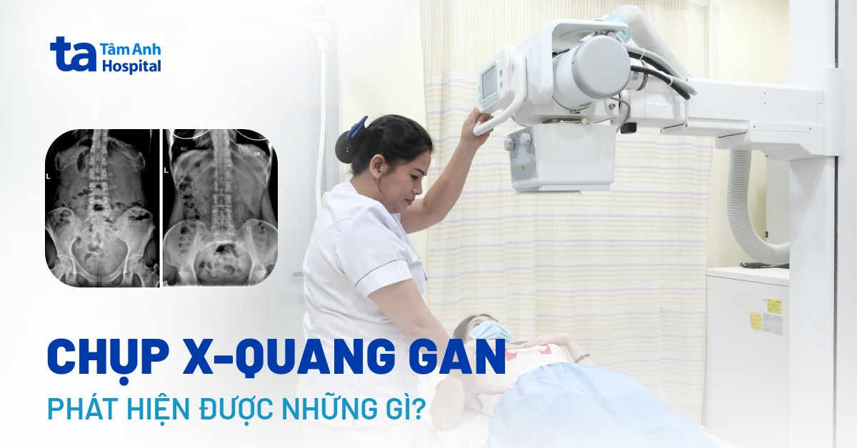 Chup X Quang Gan
