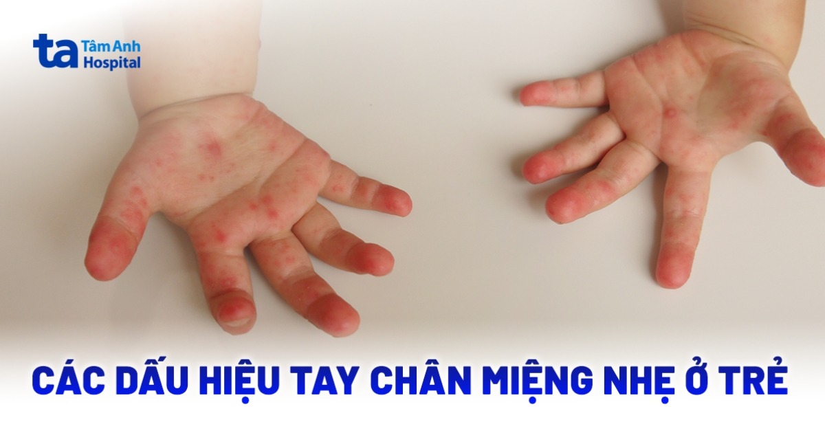 Dau Hieu Tay Chan Mieng Nhe