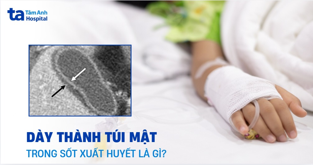 Day Thanh Tui Mat Trong Sot Xuat Huyet
