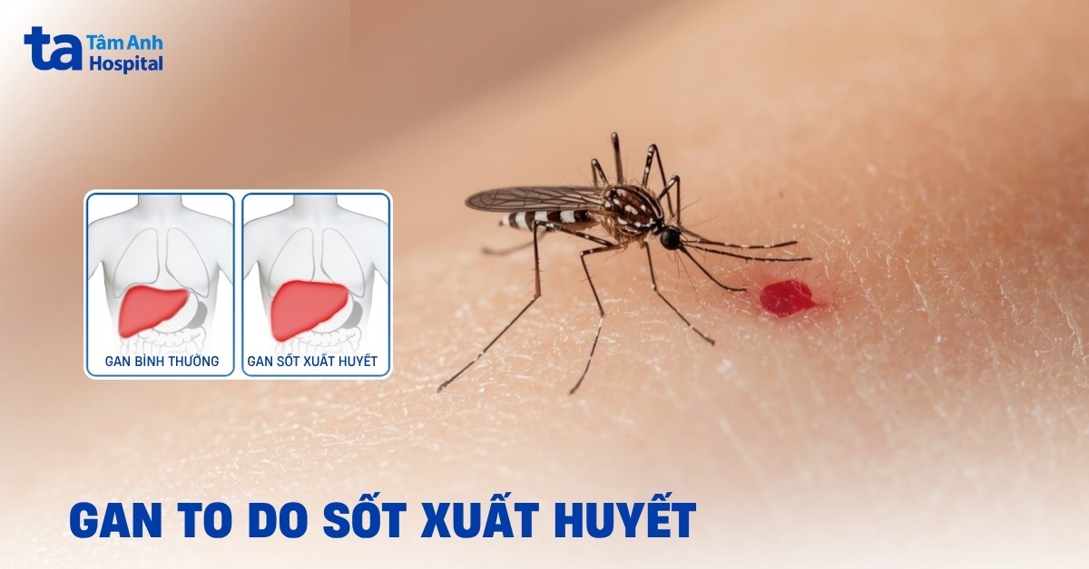 Giải Đáp: Tại Sao Gan To Trong Sốt Xuất Huyết? Gan To Trong Sot Xuat Huyet