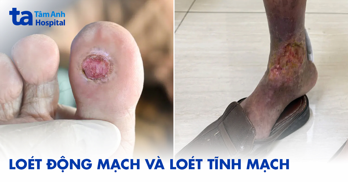 Loet Dong Mach Va Loet Tinh Mach 1