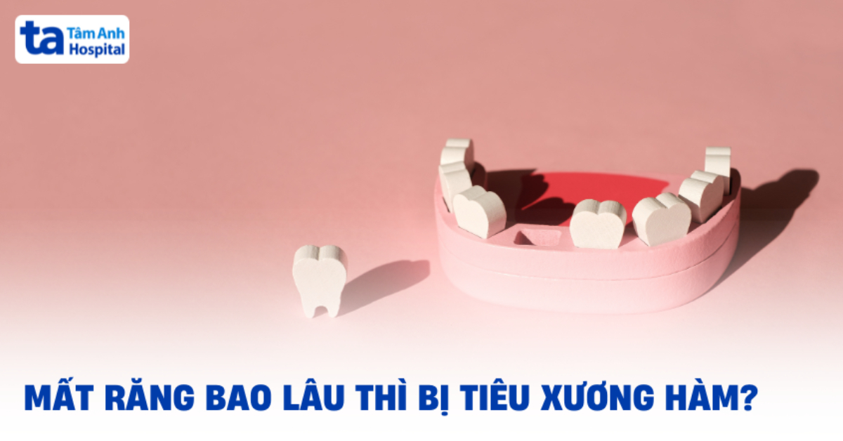 Mat Rang Bao Lau Thi Bi Tieu Xuong Ham