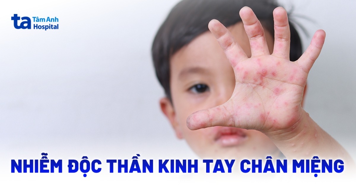 Nhiem Doc Than Kinh Tay Chan Mieng