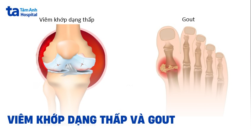 Phan Biet Gout Va Viem Khop Dang Thap