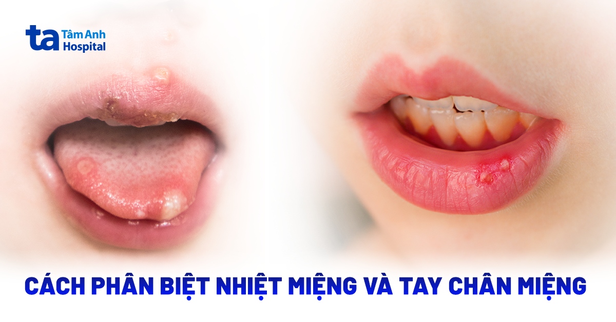 Phan Biet Nhiet Mieng Va Tay Chan Mieng