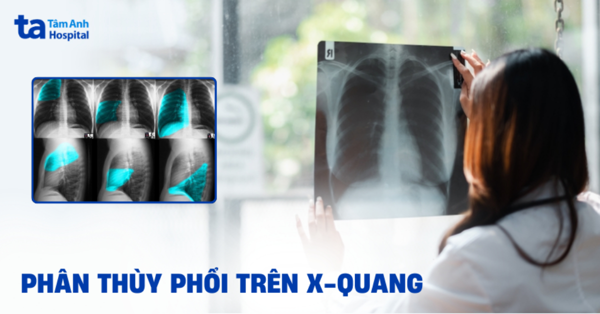 Phan Thuy Phoi Tren Phim X Quang