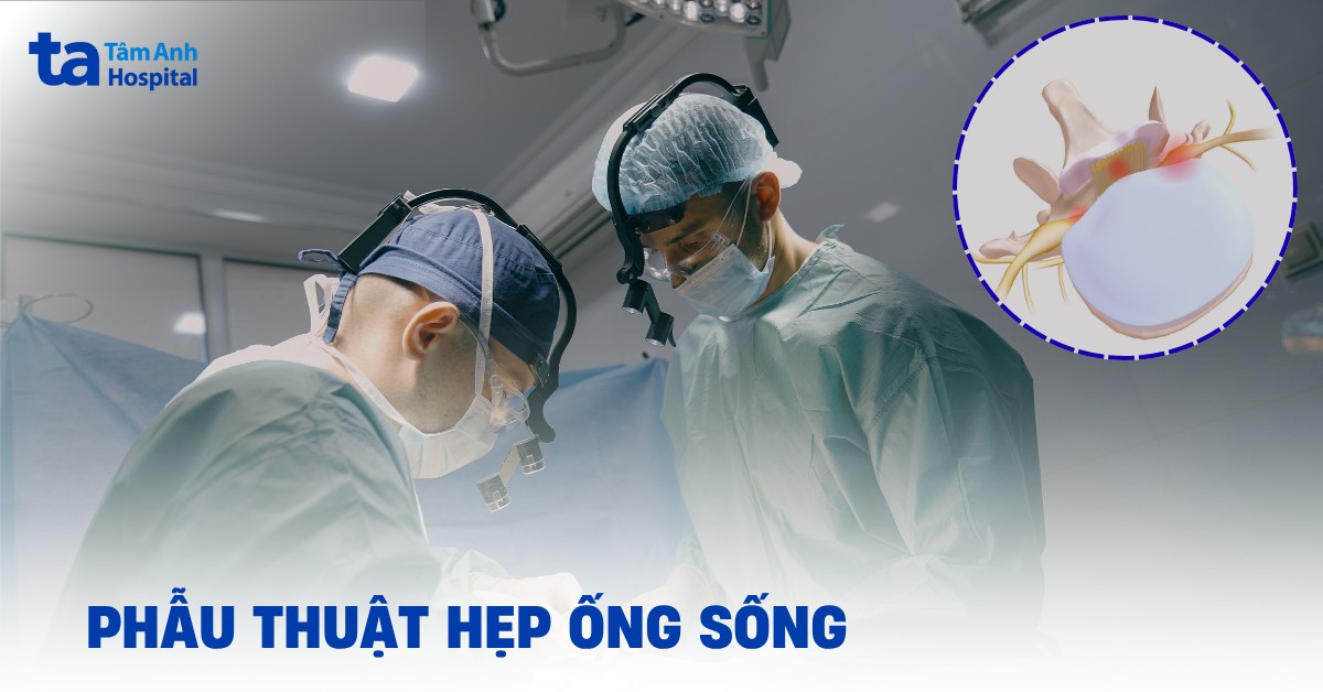 Phau Thuat Hep Ong Song