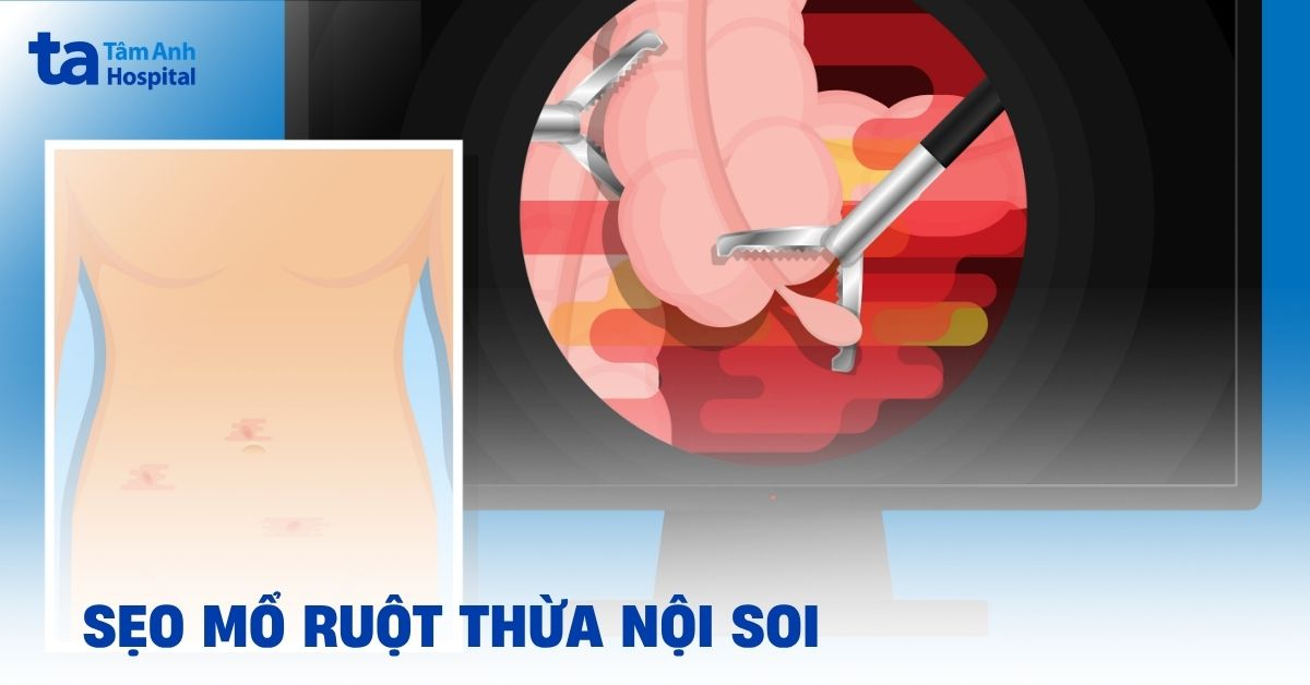 Seo Mo Ruot Thua Noi Soi