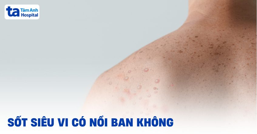 Sot Sieu Vi Co Noi Ban Khong