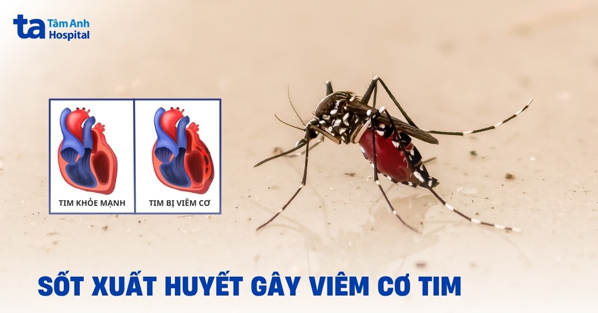 Sốt Xuất Huyết Gây Viêm Cơ Tim: Khi Nào Cần Thận Trọng? Sot Xuat Huyet Gay Viem Co Tim