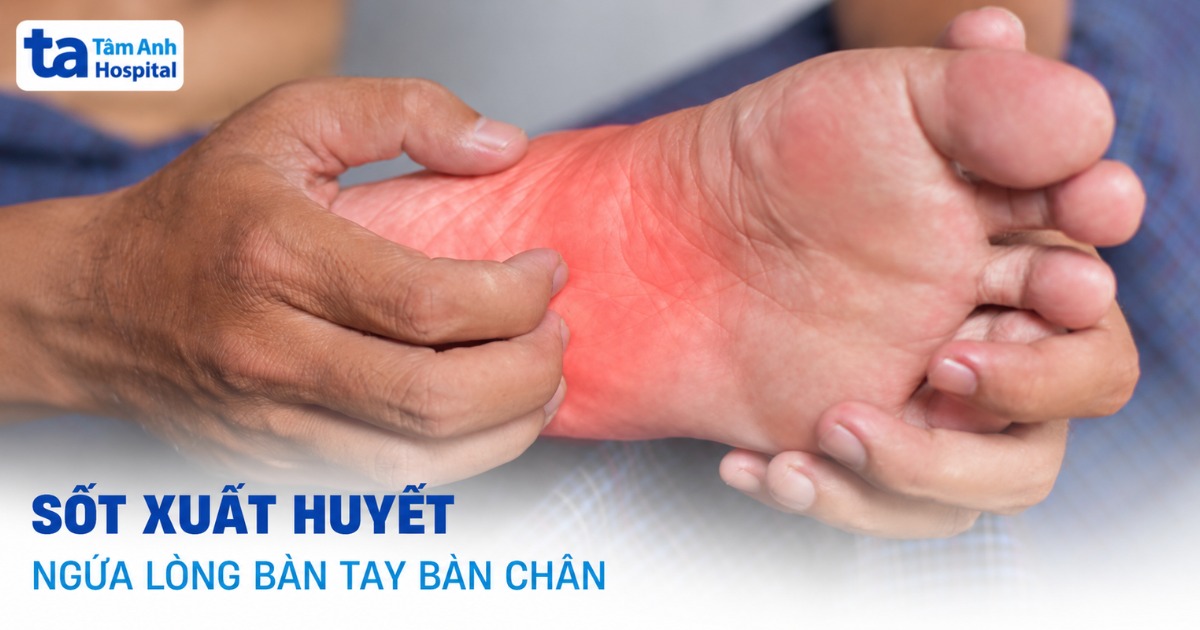 Tìm Hiểu Sốt Xuất Huyết Ngứa Lòng Bàn Tay Bàn Chân Sot Xuat Huyet Ngua Long Ban Tay Ban Chan