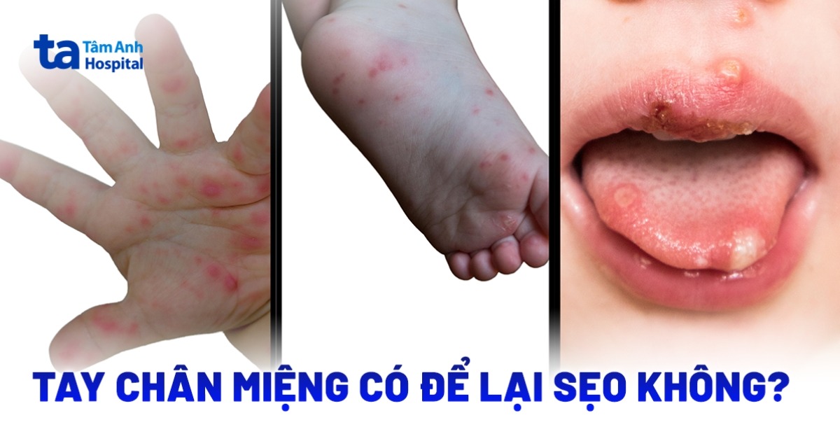 Tay Chan Mieng Co De Lai Seo Khong