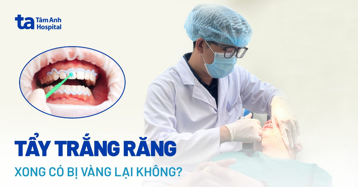 Tay Trang Rang Xong Bi Vang Lai