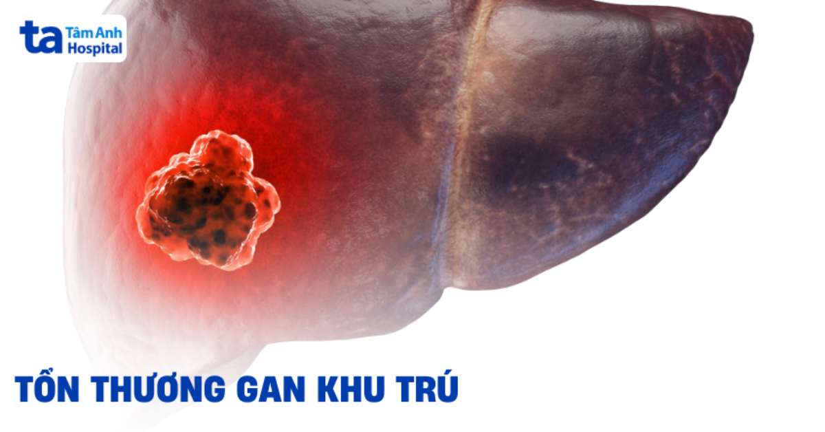 Ton Thuong Gan Khu Tru