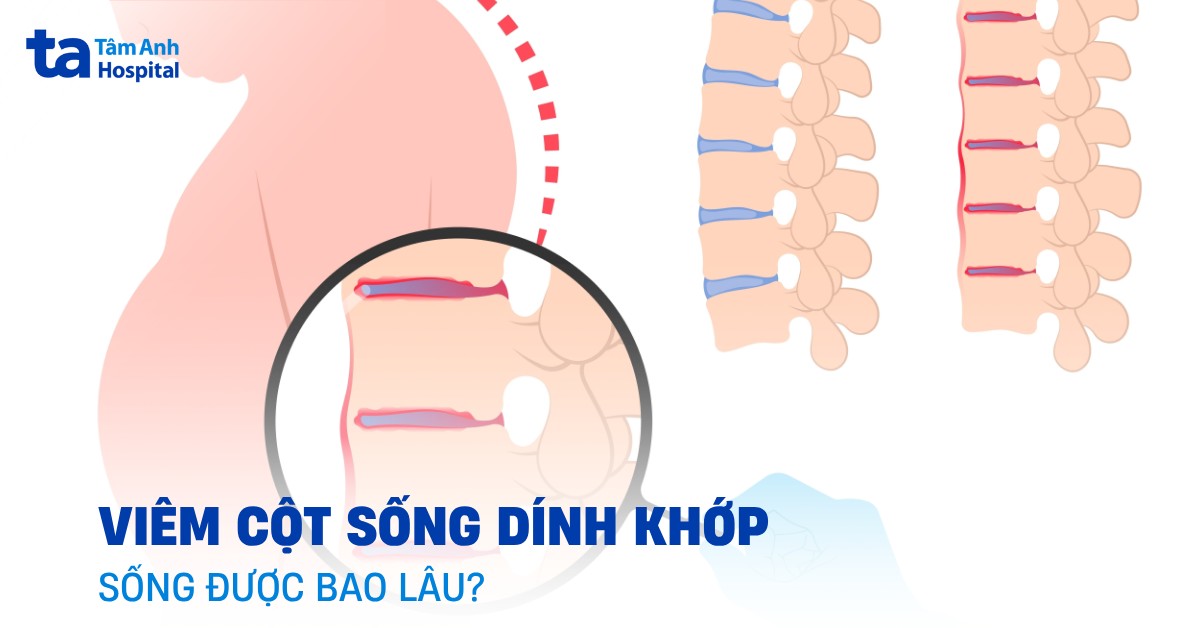 Viem Cot Song Dinh Khop Song Duoc Bao Lau