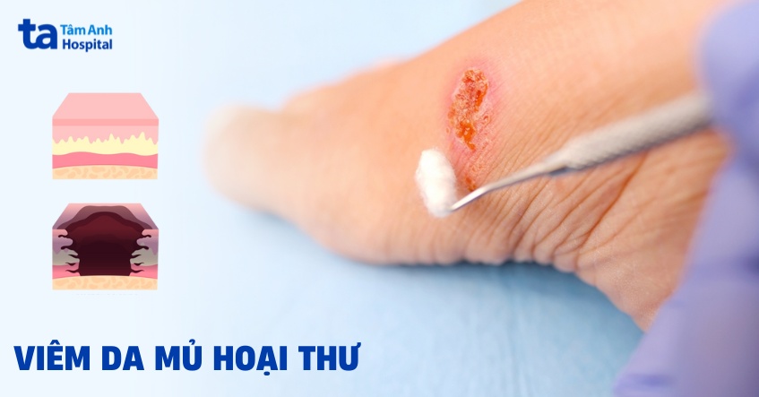 Viêm Da Mủ Hoại Thư (Pyoderma Gangrenosum) Viem Da Mu Hoai Thu