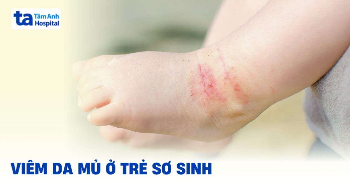 Viêm Da Mủ Ở Trẻ Sơ Sinh: Cha Mẹ Bé Cần Lưu Ý Điều Gì? Viem Da Mu O Tre So Sinh