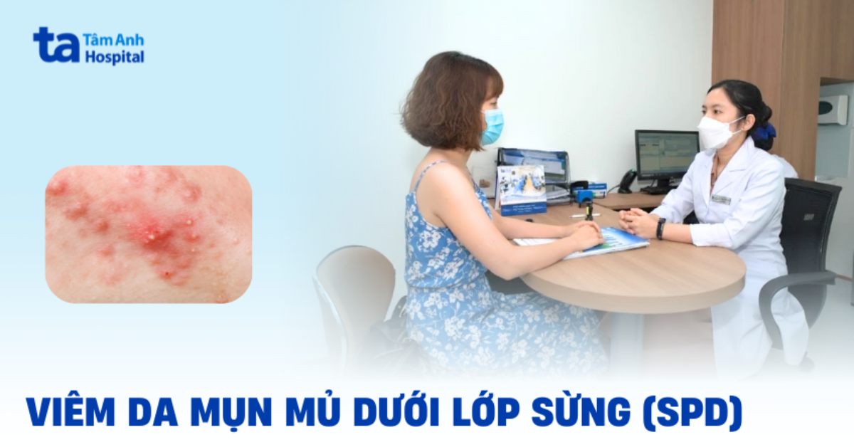 Viem Da Mun Mu Duoi Lop Sung