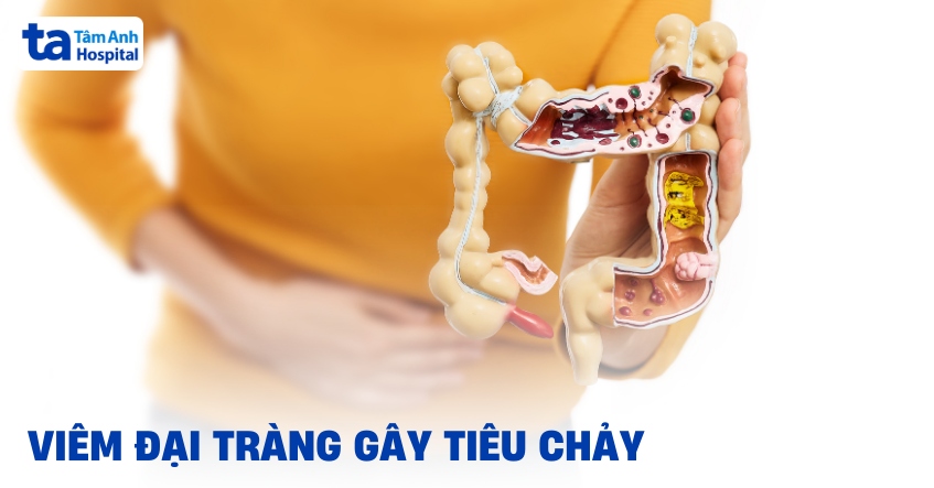 Viem Dai Trang Gay Tieu Chay