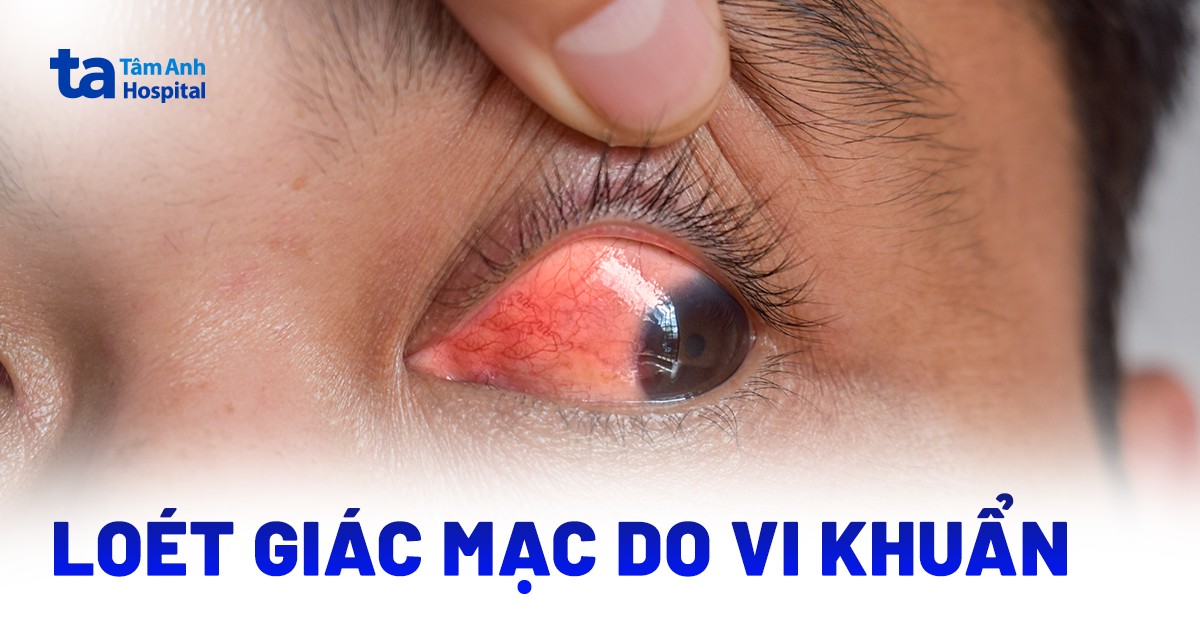 Hiểu Đúng Về Viêm Loét Giác Mạc Do Vi Khuẩn Viem Loet Giac Mac Do Vi Khuan