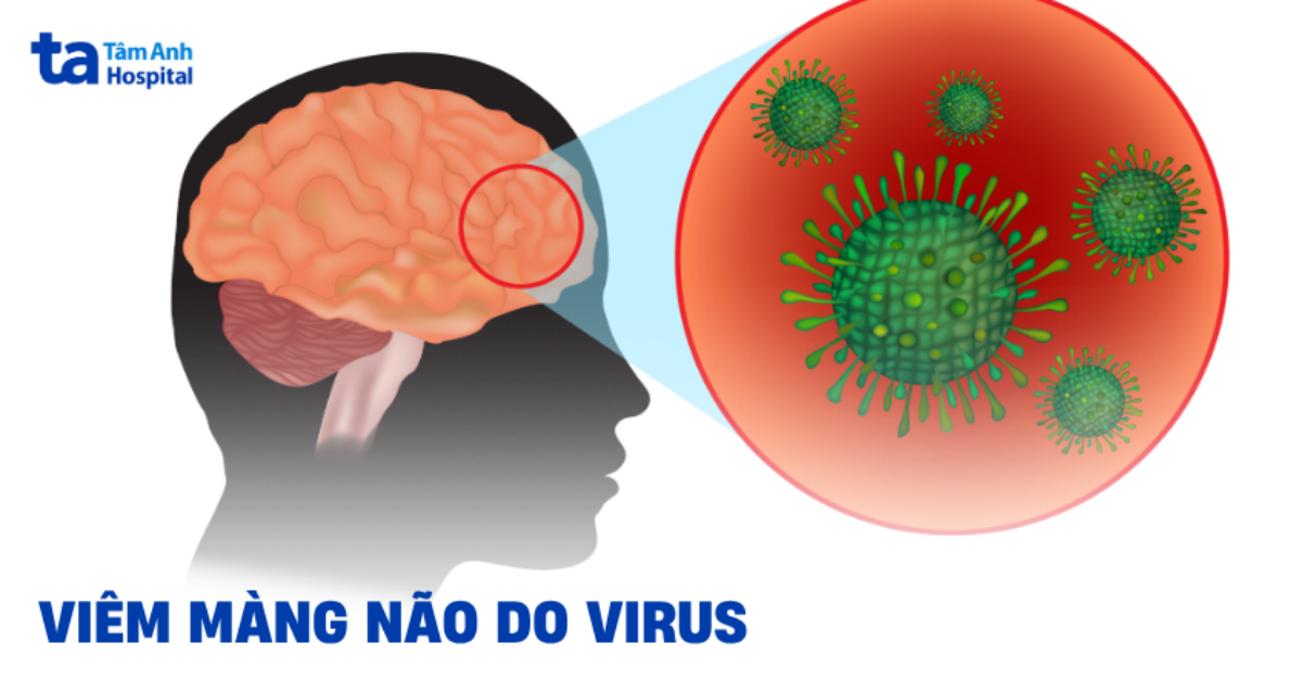 Viêm Màng Não Do Virus: Thông Tin Đầy Đủ Viem Mang Nao Do Virus
