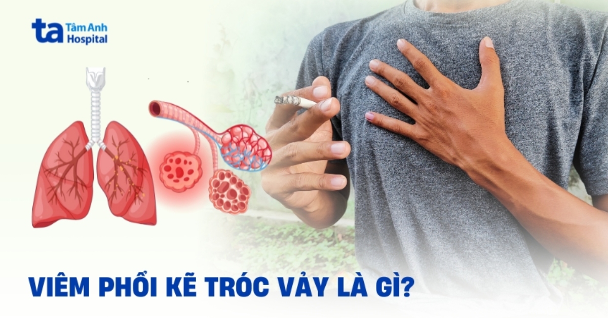 Viem Phoi Ke Troc Vay