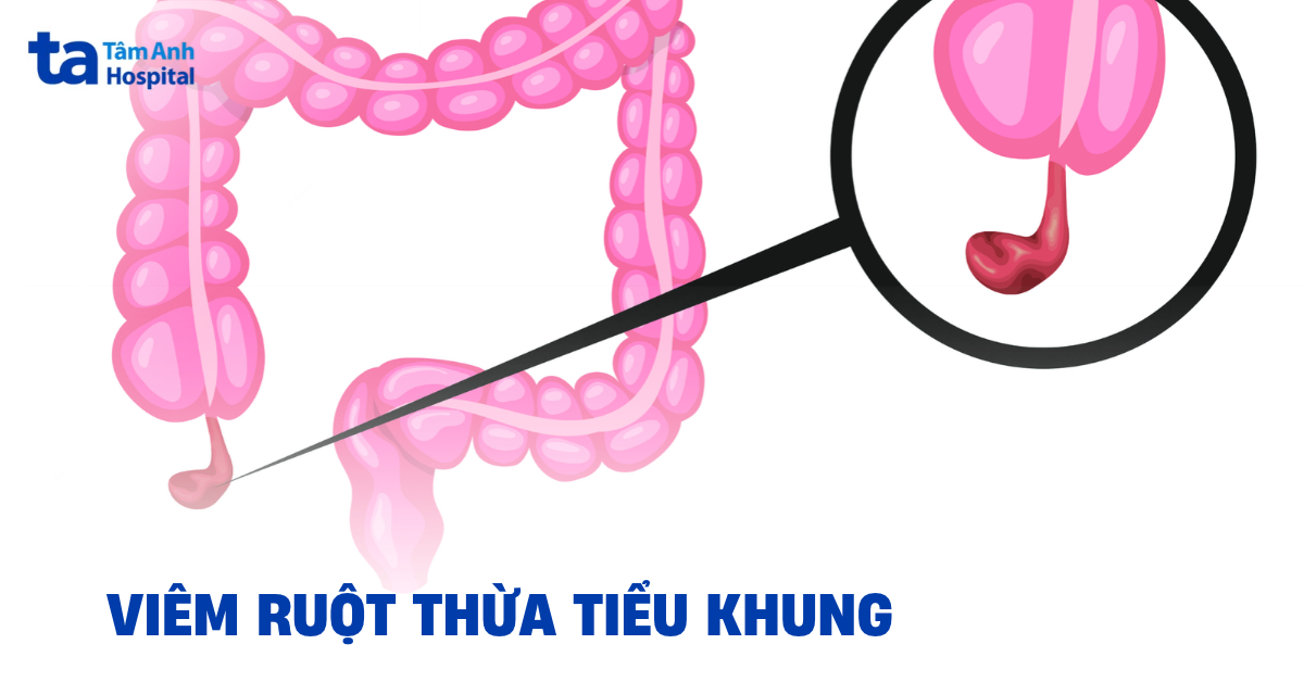 Viem Ruot Thua Tieu Khung