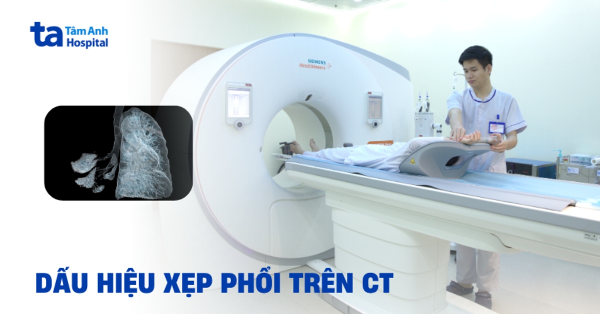 Xep Phoi Tren Ct