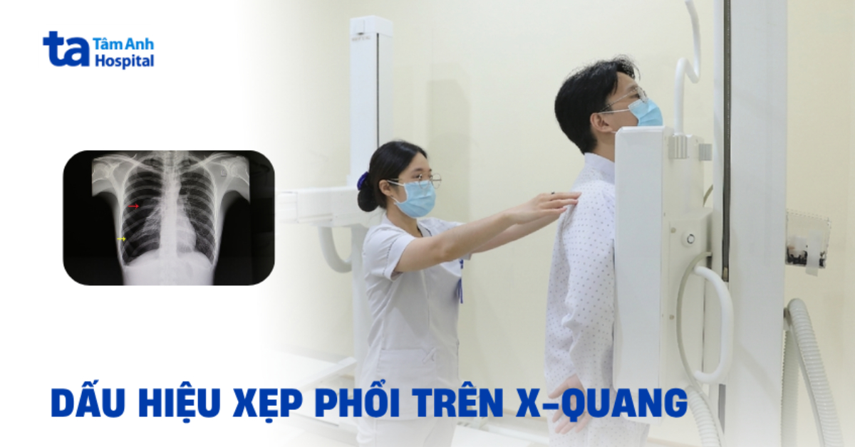 Xep Phoi Tren X Quang